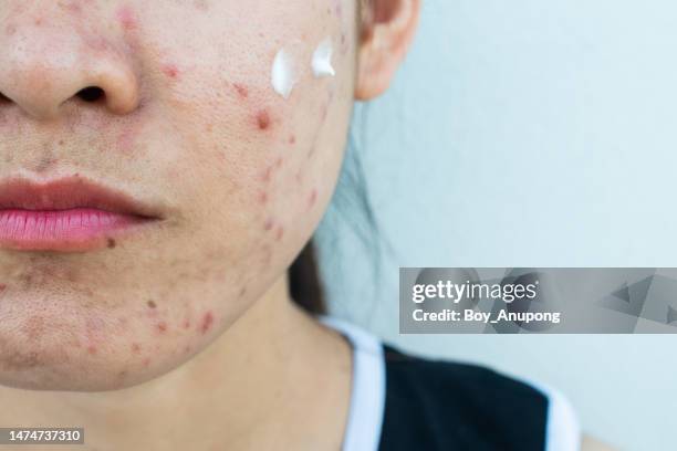 cropped shot of asian woman after applying acne cream on her face for solving acne inflammation. - abscess stockfoto's en -beelden