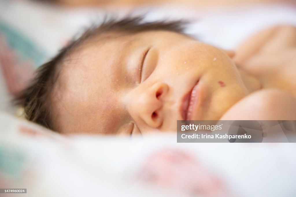 Newborn baby girl with hemangioma on face.