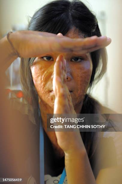 Cambodia-crime-acid-social,FEATURE by Kounila Keo This photo taken on September 21, 2010 shows Cambodian acid survivor Morm Nheb showing a time out...