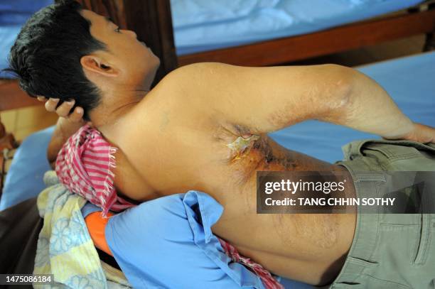 Cambodia-crime-acid-social,FEATURE by Kounila Keo This photo taken on September 21, 2010 shows a Cambodian acid survivor on a bed at the Cambodian...