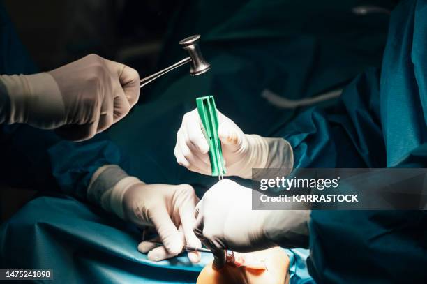 unrecognizable team of surgeons operating a foot in the hospital. health concept - implante dentário imagens e fotografias de stock