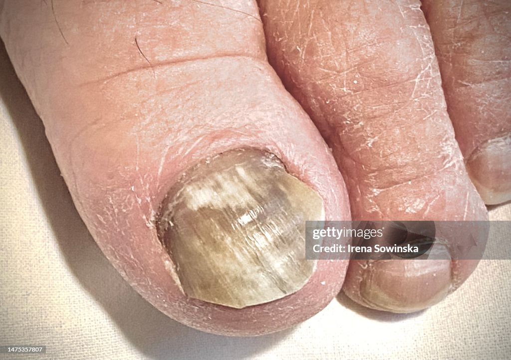 Candida auris