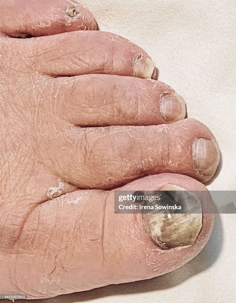 Candida auris