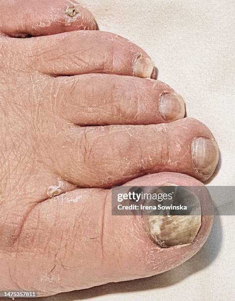 Infested Toe 405 Infected Toe Stock Photos, High-Res Pictures, and Images - Getty Images