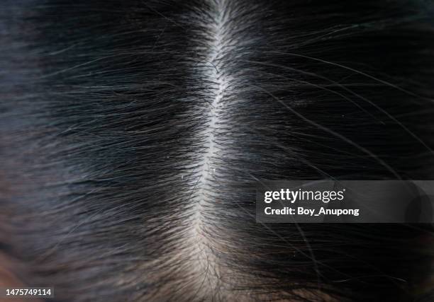 close up of dandruff problem on woman head. dandruff is a skin condition that causes itchy. - cuero cabelludo fotografías e imágenes de stock