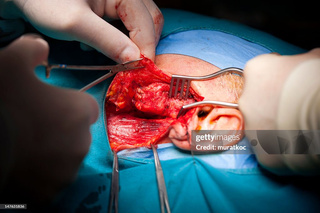 Tumor surgery