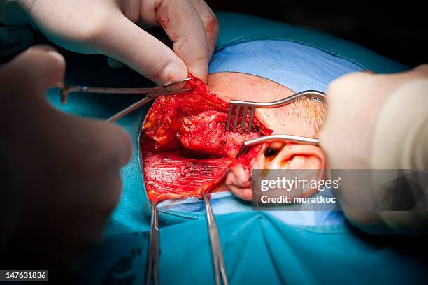 tumor surgery - forceps stock pictures, royalty-free photos & images