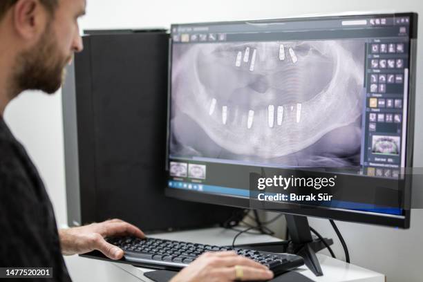 doctor examining x-ray, oral and dental diseases, dentist, dental health, implant treatment - implante imagens e fotografias de stock