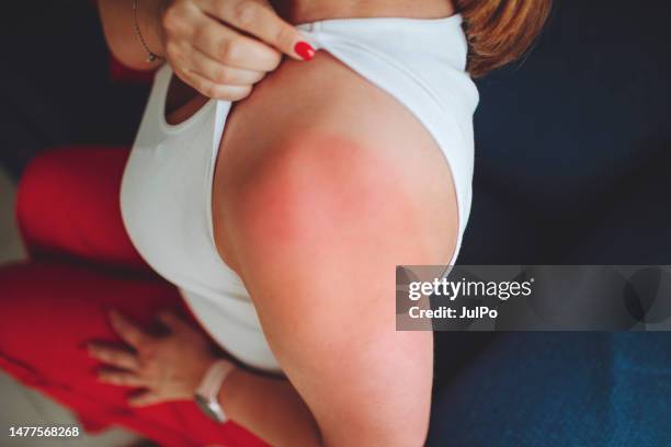 close-up of a sunburn marks on a woman's back - black light burns stock pictures, royalty-free photos & images