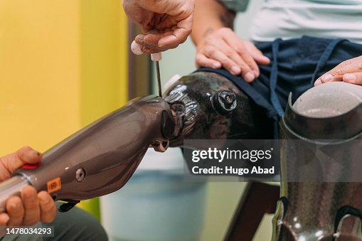 Doctor adjusting the prosthesis of an amputee patient.