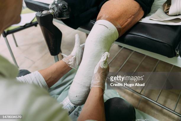 unrecognizable doctor preparing the cast for an amputated leg. - diabetic amputation stock pictures, royalty-free photos & images