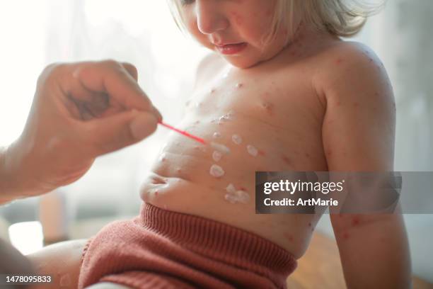 el padre aplica medicamentos antisépticos en el vientre de su pequeña niña con varicela en casa - varicela fotografías e imágenes de stock