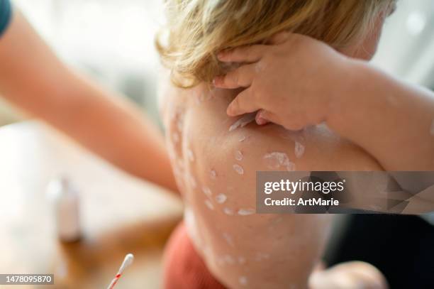 father applies antiseptic medicine to his girls backl with chickenpox at home while she is scratching rash on her shoulder - chickenpox stock pictures, royalty-free photos & images