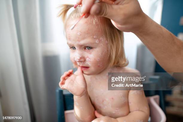 vater wendet antiseptische medizin auf sein kleines mädchen mit windpocken zu hause an - chickenpox stock-fotos und bilder