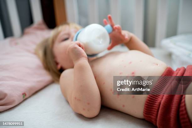 süßes krankes mädchen mit windpocken liegt in ihrem bettchen und trinkt milch - chickenpox stock-fotos und bilder