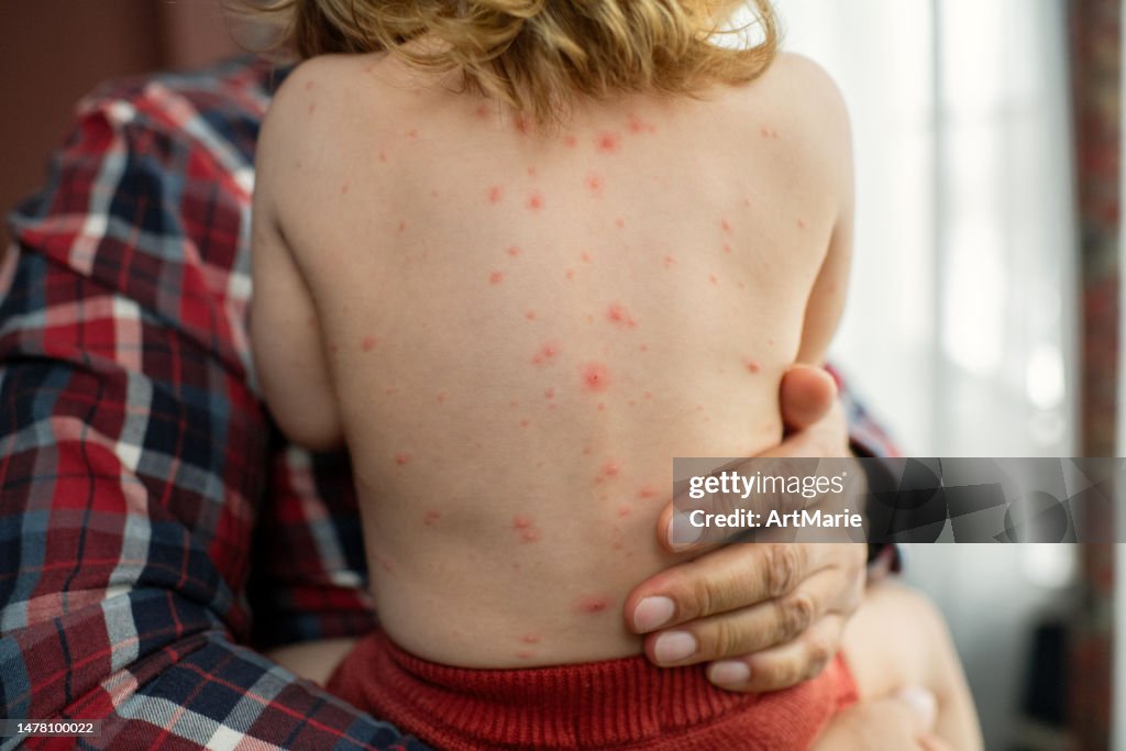 Father holding his little daughter with chickenpox infection