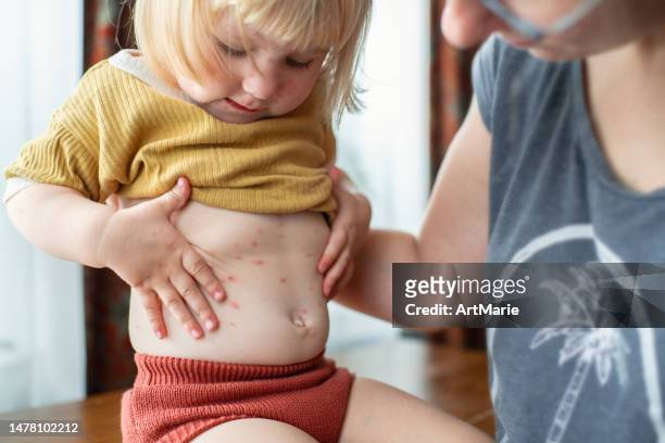 mother with her little daughter with chickenpox infection - little kids belly imagens e fotografias de stock