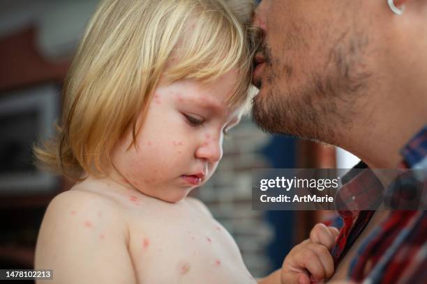 padre sosteniendo a su pequeña hija con infección de varicela - varicela fotografías e imágenes de stock