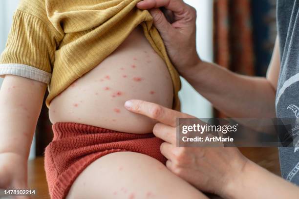 mutter mit ihrer kleinen tochter mit windpockeninfektion - chickenpox stock-fotos und bilder