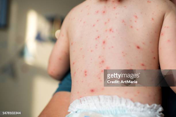 vater hält seine kleine tochter mit windpockeninfektion im arm - chickenpox stock-fotos und bilder