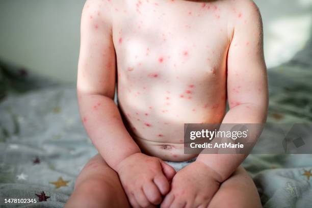 little girl with chickenpox all over her body at home - shingles illness stock pictures, royalty-free photos & images