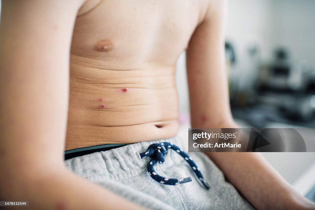 Unrecognizable ill child with chickenpox blisters on skin