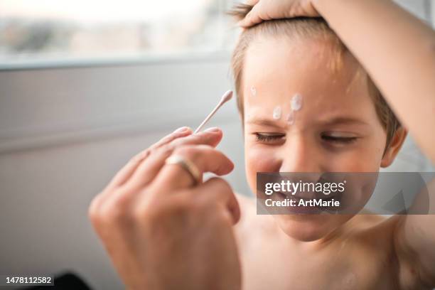 father applies antiseptic medicine against chickenpox to his little boy at home - varicella zoster virus stock pictures, royalty-free photos & images