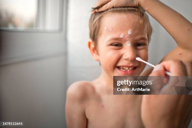 father applies antiseptic medicine against chickenpox to his little boy at home - varicella zoster virus stock pictures, royalty-free photos & images