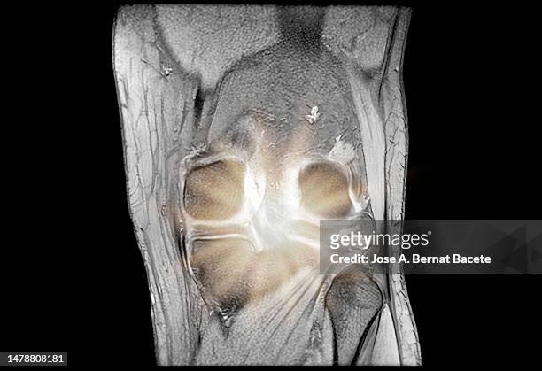 magnetic resonance imaging mri knee with pain simulation. - cartilage bildbanksfoton och bilder