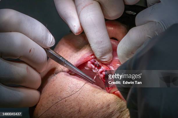 high angle view dentist perform surgical suture on chinese senior patient in dental chair - root canal procedure stock pictures, royalty-free photos & images