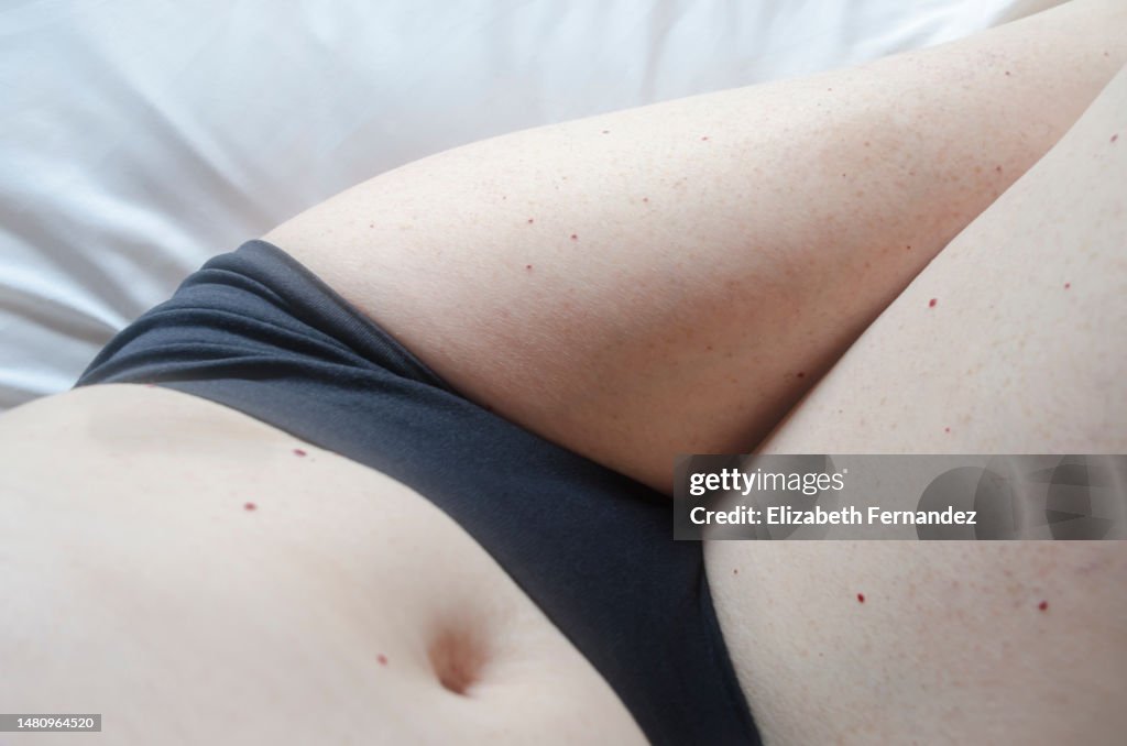 Skin problems - Cherry Angiomas