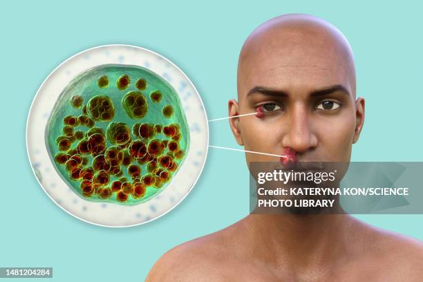 ilustrações de stock, clip art, desenhos animados e ícones de nasal and ocular rhinosporidiosis, illustration - human nose