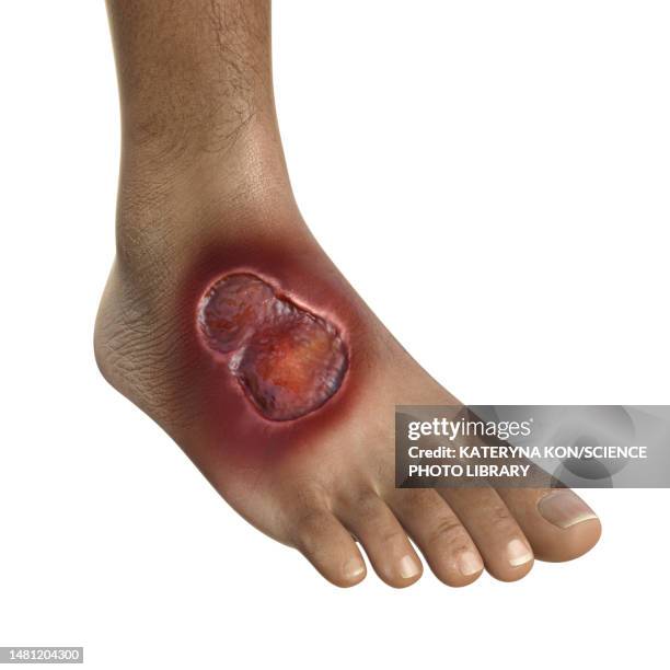 buruli ulcer on a foot, illustration - mycobacterium stock illustrations