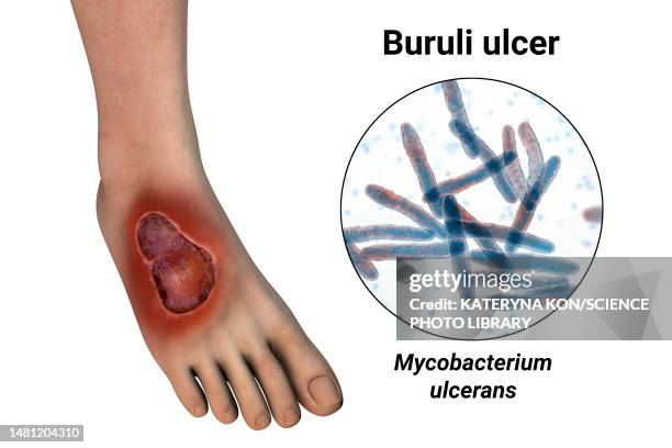 buruli ulcer and mycobacterium ulcerans, illustration - mycobacterium stock illustrations