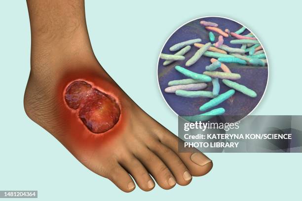 buruli ulcer and mycobacterium ulcerans, illustration - mycobacterium stock illustrations