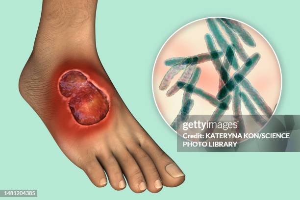 buruli ulcer and mycobacterium ulcerans, illustration - mycobacterium stock illustrations