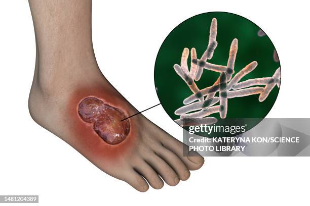 buruli ulcer and mycobacterium ulcerans, illustration - mycobacterium stock illustrations