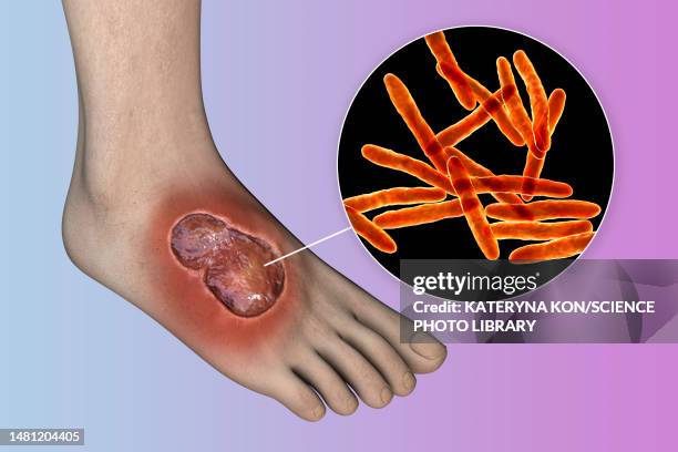 buruli ulcer and mycobacterium ulcerans, illustration - mycobacterium stock illustrations