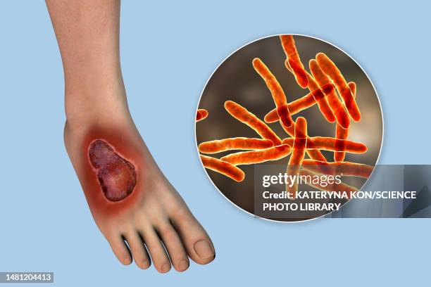 buruli ulcer and mycobacterium ulcerans, illustration - mycobacterium stock illustrations