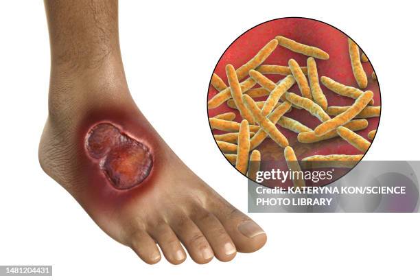 buruli ulcer and mycobacterium ulcerans, illustration - mycobacterium stock illustrations