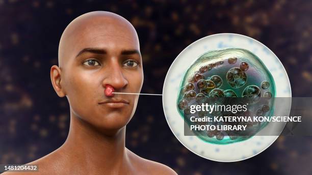 stockillustraties, clipart, cartoons en iconen met nasal rhinosporidiosis, illustration - human nose
