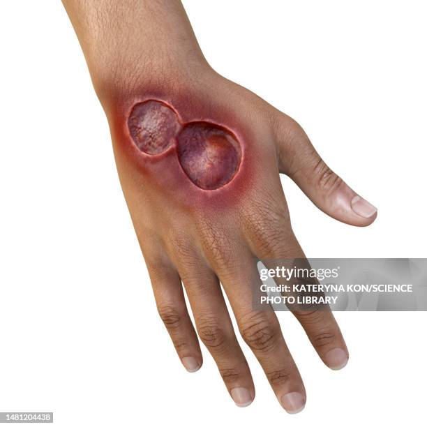 buruli ulcer on a hand, illustration - mycobacterium stock illustrations