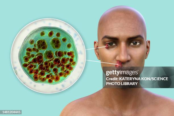 nasal and ocular rhinosporidiosis, illustration - nasal passage stock illustrations