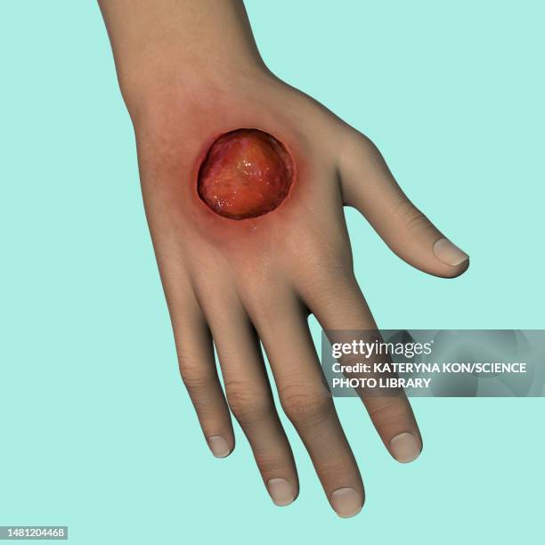 buruli ulcer on a hand, illustration - mycobacterium stock illustrations
