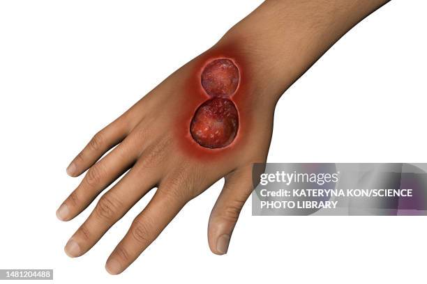 buruli ulcer on a hand, illustration - mycobacterium stock illustrations