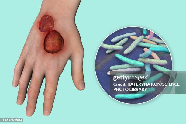 buruli ulcer and mycobacterium ulcerans, illustration - mycobacterium stock illustrations