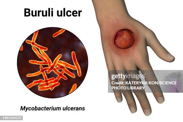 buruli ulcer and mycobacterium ulcerans, illustration - mycobacterium stock illustrations
