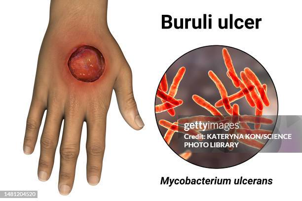 buruli ulcer and mycobacterium ulcerans, illustration - mycobacterium stock illustrations