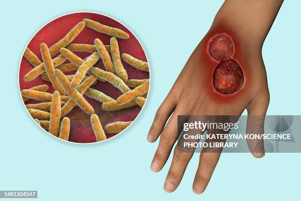 buruli ulcer and mycobacterium ulcerans, illustration - mycobacterium stock illustrations