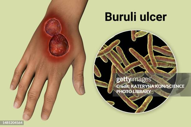 buruli ulcer and mycobacterium ulcerans, illustration - mycobacterium stock illustrations